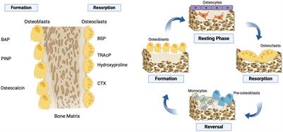 Mild autonomous cortisol secretion leads to reduced volumetric BMD at lumbar spine in patients with primary aldosteronism